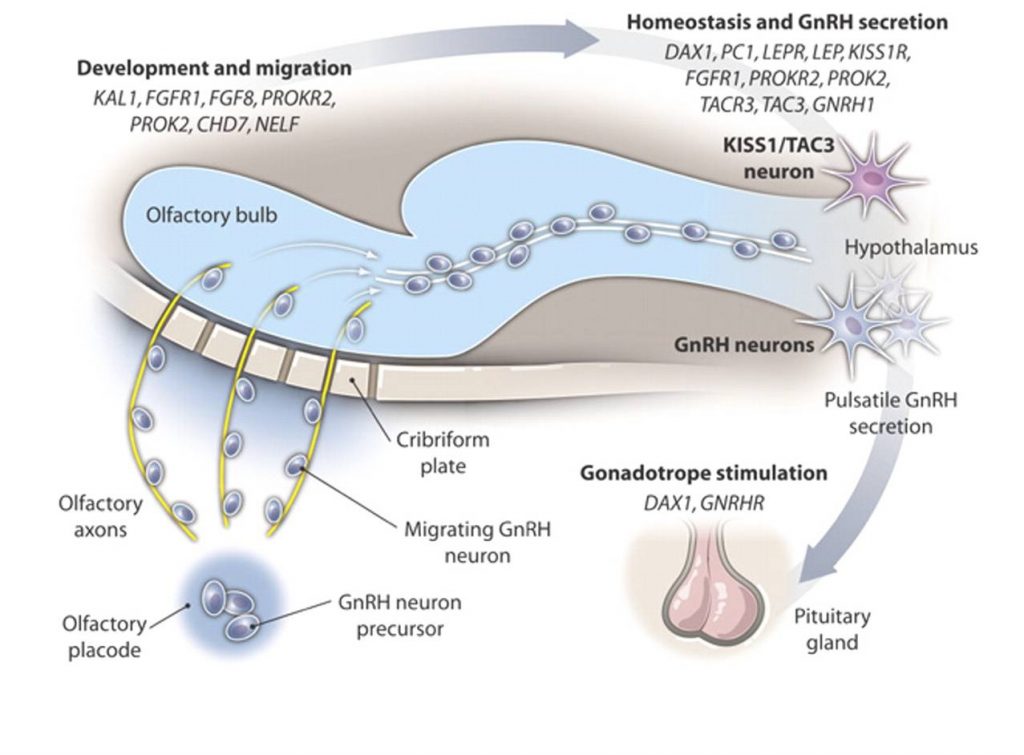 Kallman syndrome