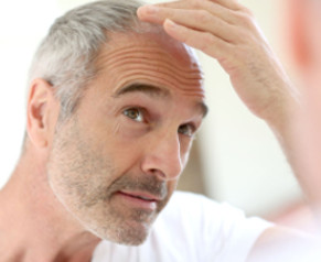 male-pattern-hair-loss